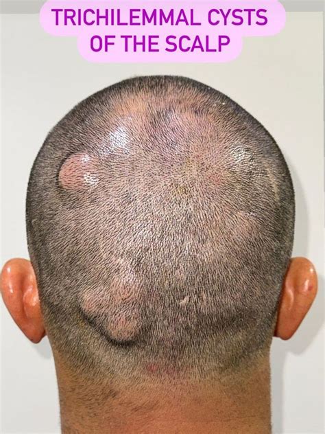 trichilemmal cyst diagnosis.